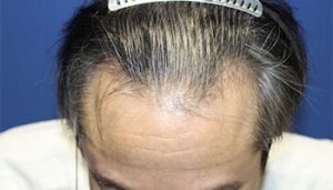 60代 男性 I.M.さん　愛知 植毛(MIRAI法) 2,500株の症例