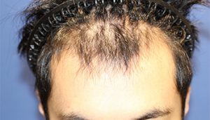20代 男性 A.N.さん　　生え際　前頭部 植毛(MIRAI法)