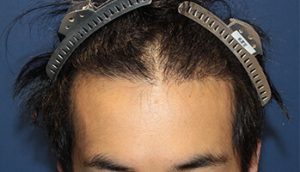 20代 男性 A.N.さん　　生え際　前頭部 自毛植毛(MIRAI法)