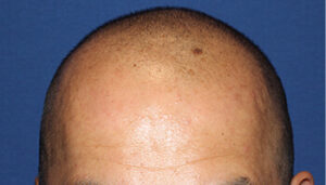 40代 男性 U.A.さん　生え際・前頭部・頭頂部の自毛植毛(MIRAI法)3,000株の症例