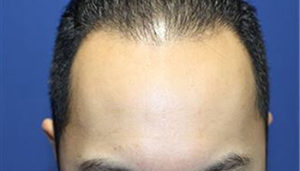 30代 男性 W.T.さん　生え際の愛知 植毛(MIRAI法)1,200株の症例