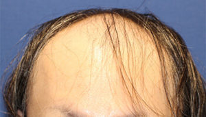 30代 男性 A.T.さん生え際・前頭部・頭頂部の自毛植毛(MIRAI法)3,000株の症例 愛知 症例