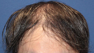 30代 男性 A.T.さん生え際・前頭部・頭頂部の自毛植毛(MIRAI法)3,000株の症例 名古屋 症例