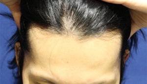 20代 男性 S.K.さん　植毛(MIRAI法) 1,400株の症例 名古屋 症例