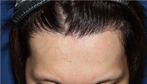 20代 男性 S.K.さん　植毛(MIRAI法) 1,400株の症例 愛知 症例