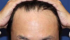40代 男性 O.M.さん 自毛植毛(MIRAI法) 1,700株の症例 愛知 症例