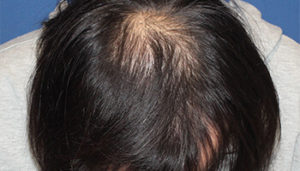 30代 男性 N.N.さん　植毛(NC-MIRAI法) 2,000株の名古屋 症例