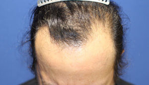 50代 男性 T.Mさん　自毛植毛(MIRAI法) 3,700株の症例 愛知 植毛